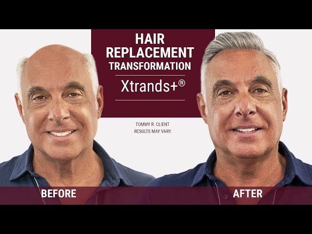 The Secret to looking Younger with Hair Replacement