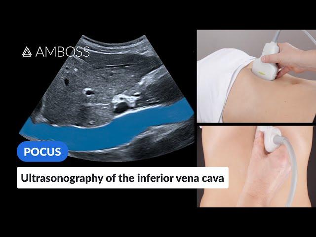 Point of Care Ultrasound of the Inferior Vena Cava (IVC) - AMBOSS Video