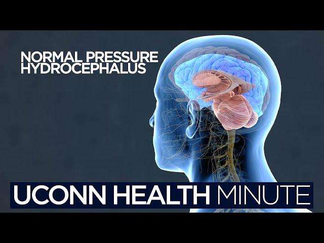 UConn Health Minute: Normal Pressure Hydrocephalus