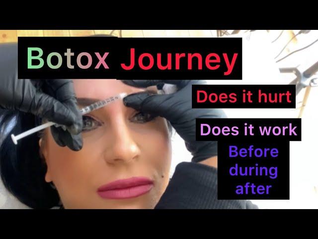 First time BOTOX what to expect, did it work ? Does it hurt? full journey botox Before and after