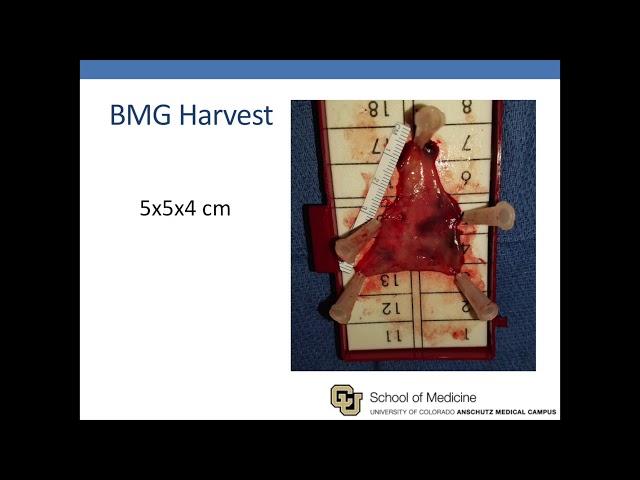 Flynn Technique for Bladder Neck Reconstruction: Robotic Subtrigonal Buccal Graft Inlay