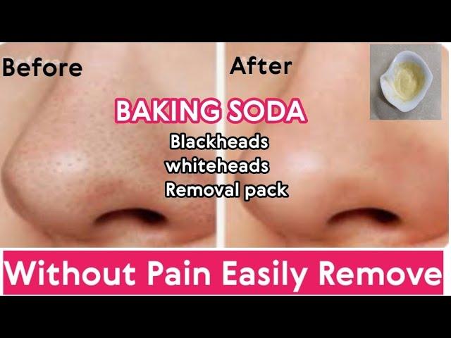 Blackheads Whiteheads Removal Pack | Easily Remove At Home | Homeremedies | Nida Naseer