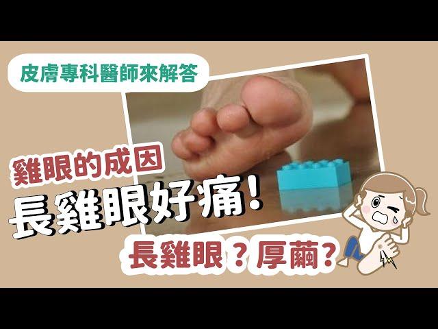 【皮膚專科醫師來解答】雞眼是如何形成的? 雞眼的成因，日常生活中那些習慣會造成雞眼?