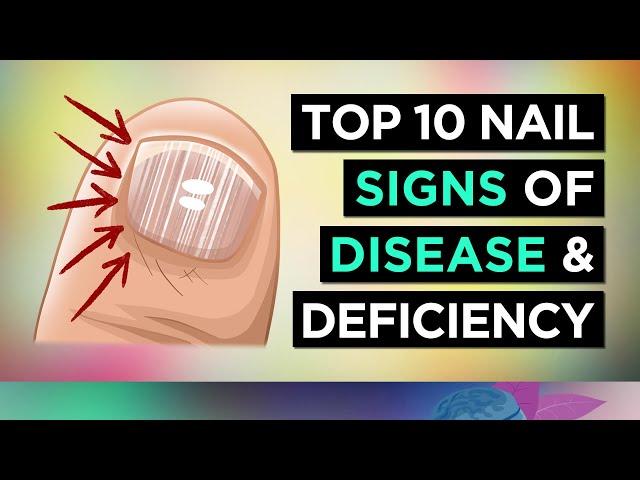 10 NAIL SIGNS of HEALTH PROBLEMS (and Nutritional Deficiencies)