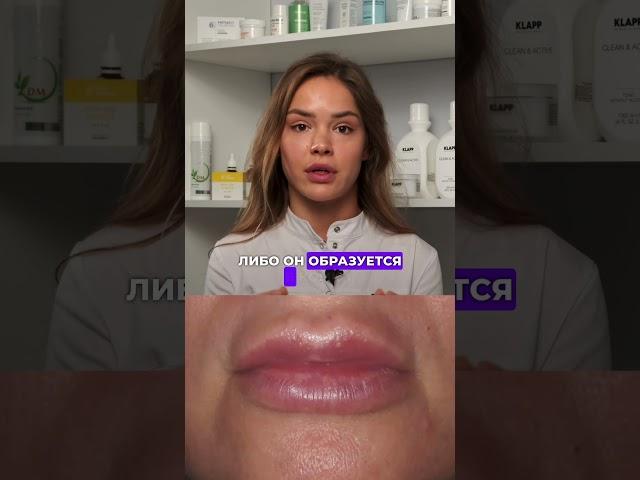 Что такое миграция филлера при увеличении губ #косметология  #врачкосметолог #увеличениегуб