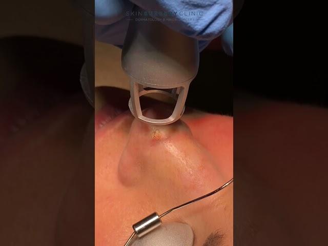 Laser Mole Removal - Teaser