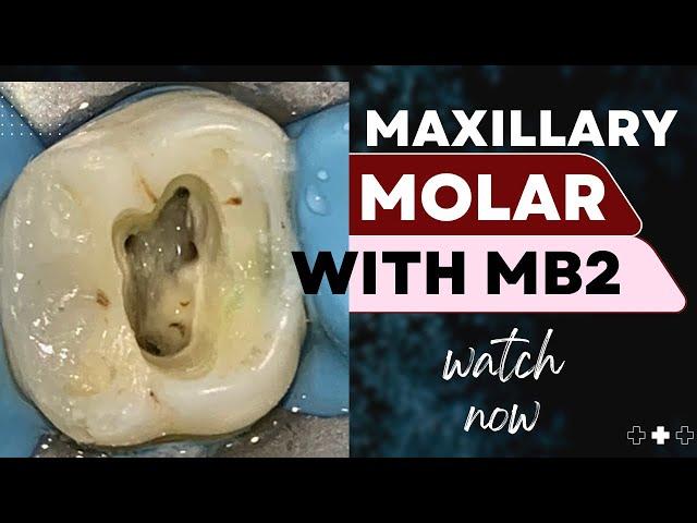 Maxillary Molar with MB2