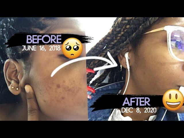 Let's talk about skin || HOW I IMPROVED MY HYPERPIGMENTATION || Dan & Dee TV