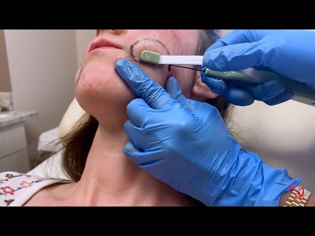 Non-Surgical Buccal Fat Removal at The Dermatology, Laser & Vein Center