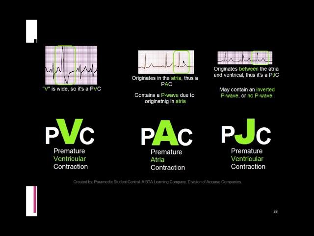 EKG itu Gampang Sesi 4(Latihan Tentang Aritmia, level pemula)