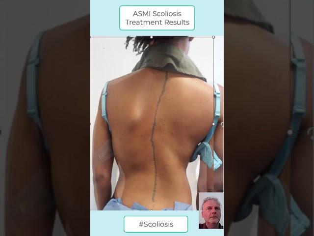 4 Sessions of the Amazing Non-Surgical ASMI Treatment for Scoliosis #scoliosistherapy