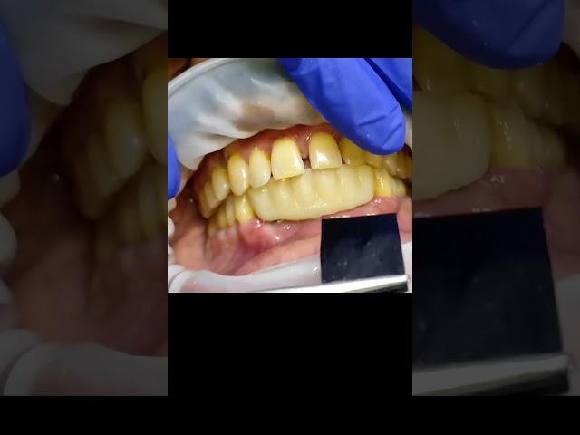 6 unit lower anterior PMMA implant bridge trial (before gum addition ) for occlusal clearance! ##