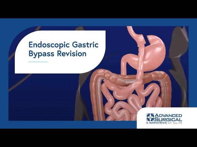 Endoscopic Gastric Bypass Revision