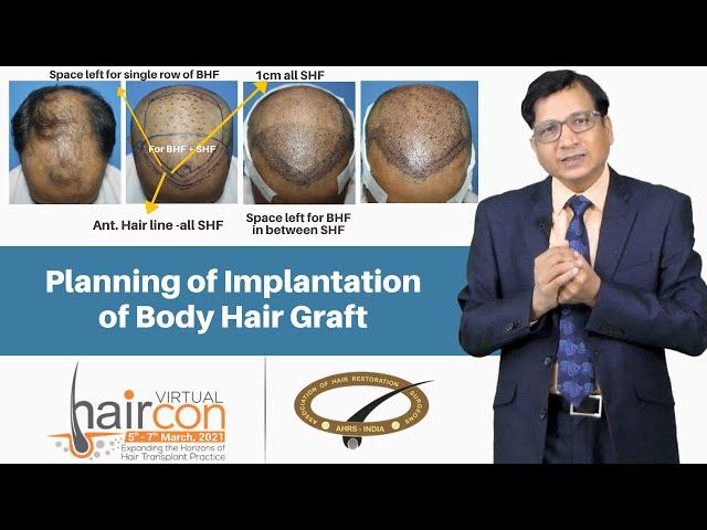 Planning of Implantation of Body Hair Graft | Dr. Anil Garg