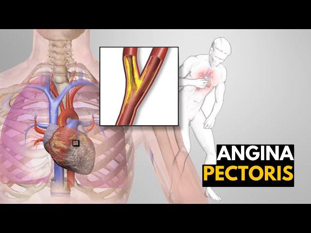 What is Angina Pectoris? Causes, signs and symptoms, Diagnosis and treatment.