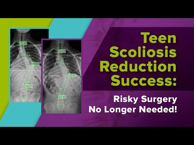 Teen Scoliosis Reduction Success: Risky Surgery No Longer Needed!