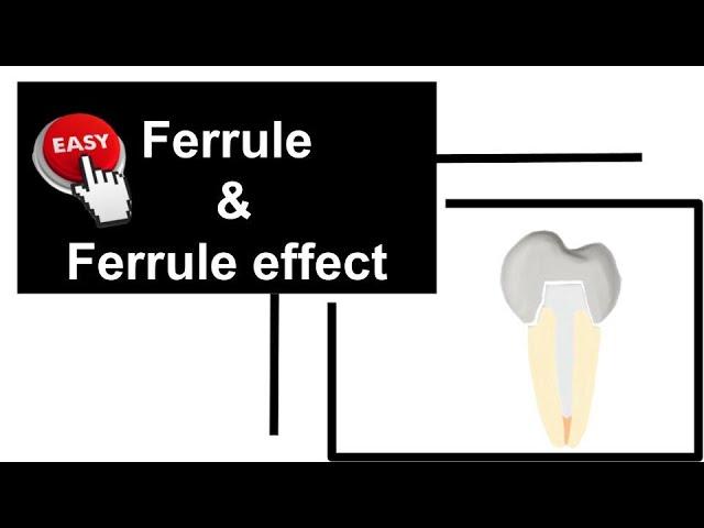 Ferrule and ferrule effect | Tooth preparation| Prosthodontics| Endodontics| Dental tuition.