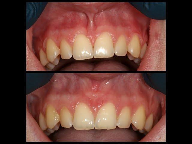 Maxillary Laser Lip Frenectomy