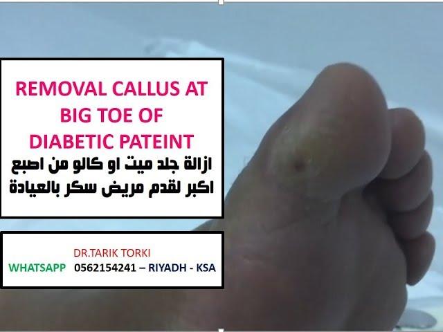 REMOVAL CALLUS AT BIG TOE OF  DIABETIC PATEINT |  ازالة جلد ميت او كالو من اصبع اكبر لقدم مريض سكر