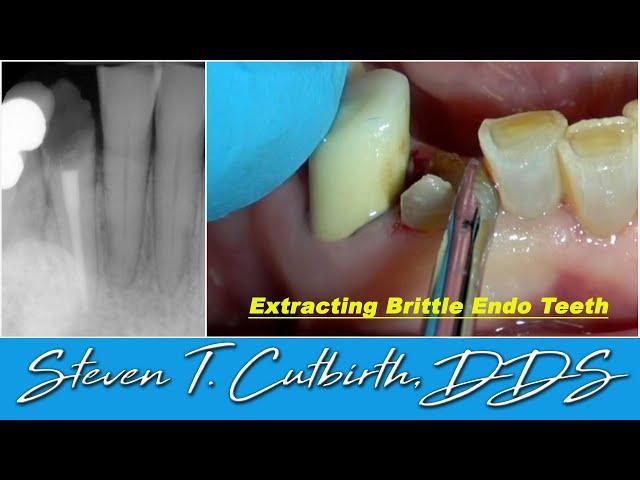 Extracting Brittle Endo Teeth - Dental Minute with Steven T. Cutbirth, DDS