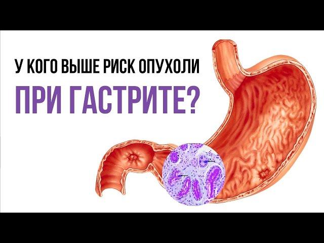  ГАСТРИТ плюс жировой гепатоз - опасное сочетание: увеличивает риск опухоли желудка!