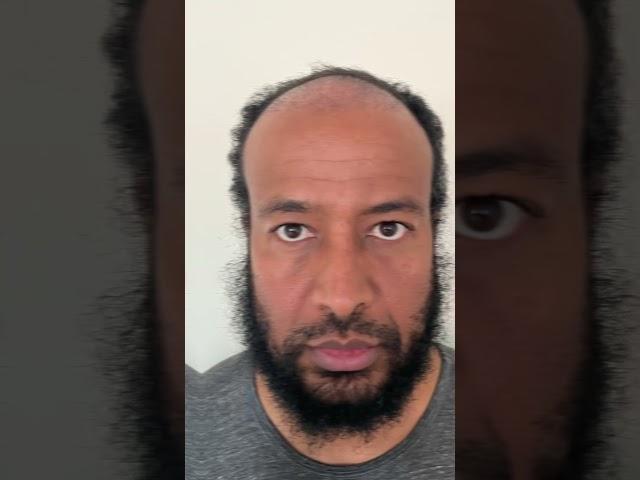 1 Year Afro Hair Transplant Turkey Results #shorts #hairtransplant #hairtransplantturkey