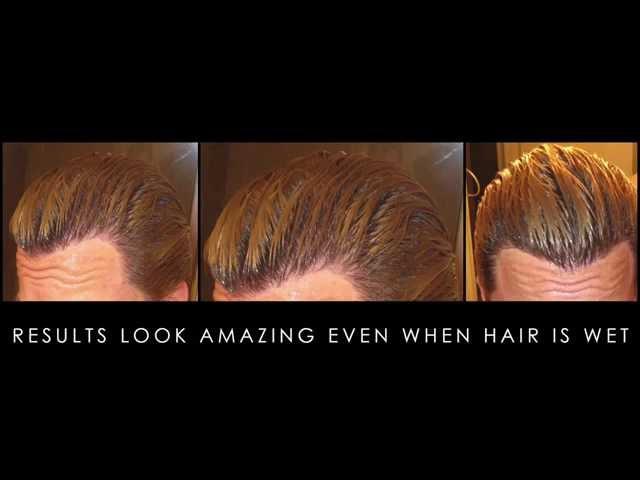 Best Hair Transplant Results – alviarmani