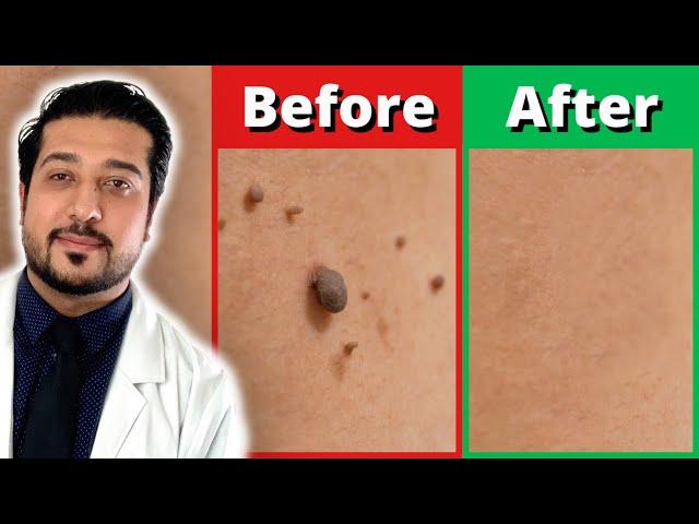 How to Rid Skin Tags FASTER | 3 Easy Skin Tag Removal Steps