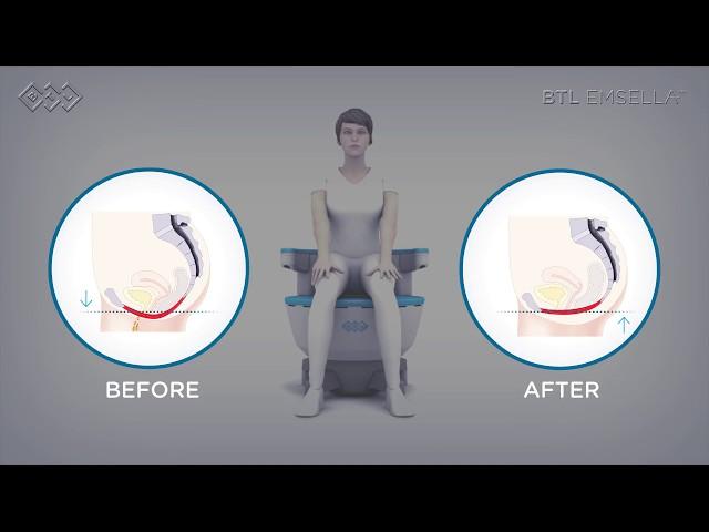 BTL EMSELLA® - Mechanism of action