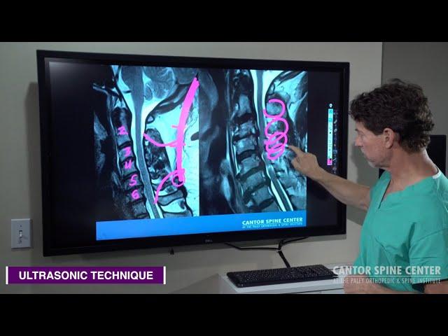 Cervical Stenosis: Traditional Technology vs. Newer Ultrasonic Technology for Spine Surgery