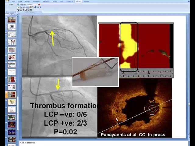 Coronary Near-Infrared Spectroscopy Review - part 2