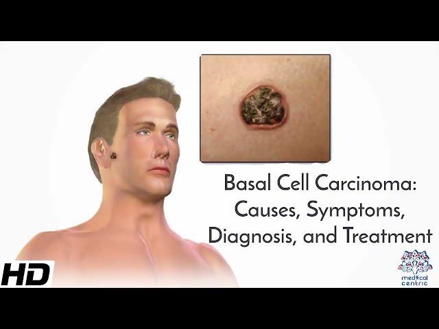 Basal Cell Carcinoma: Causes, Symptoms, Diagnosis and Treatment.