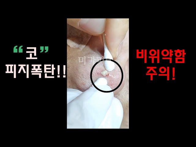 속시원한 여드름압출 !코,입술에 블랙헤드 노란피지 덩어리 폭팔!!