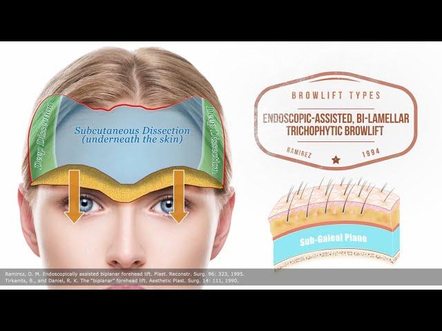 Brow Lift 101 : Differences between brow lifting techniques - Part II | Aesthetic Minutes #Browlift