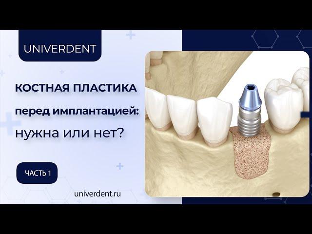 Костная пластика перед имплантацией зубов: нужна или нет? Часть 1.