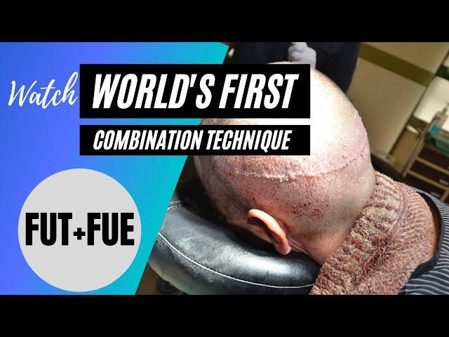 World's First Combination FUE+FUT hair transplant | Darling Buds Clinic