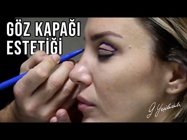 Göz Kapağı Estetiği | Güray Yeşiladalı #blepharoplasty #Eyelidaesthetic #GürayYeşiladalı