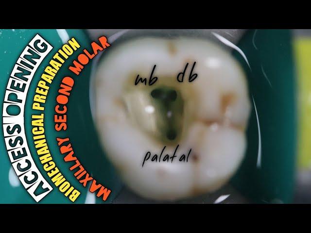 Access Opening in Maxillary Second Molar |Biomechanical Preparation | Protaper Rotary Endodontics