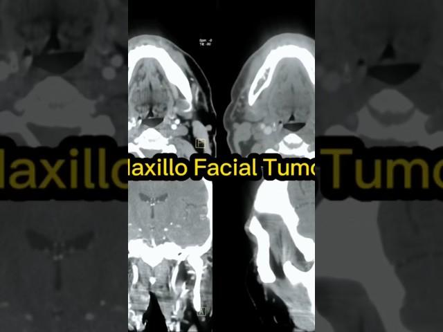 Maxillo Facial Tumor #cancer #facebook #اشعة #maxilla #medical #reels #learning #maxillofacial