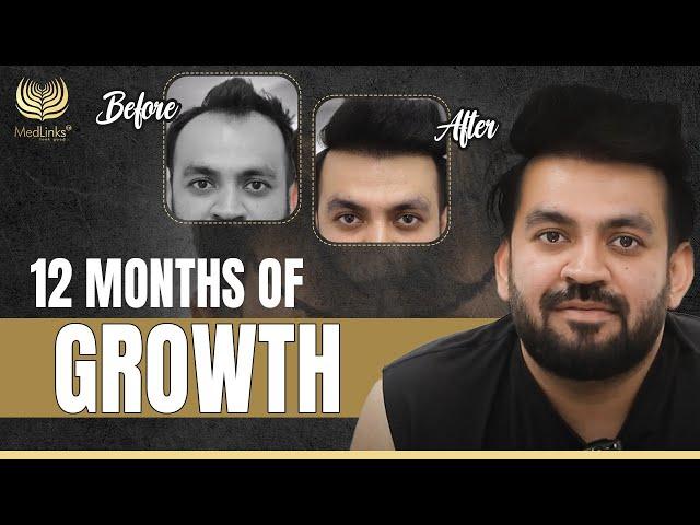 1 Year Post-Hair Transplant | 12 Months of Growth | MedLinks