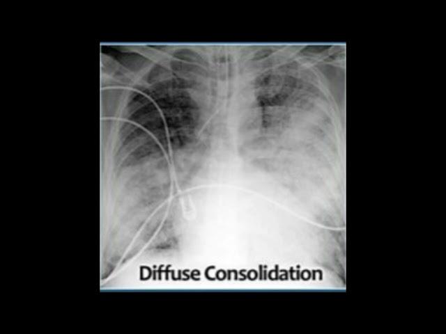 Abnormal x rays interpretation - Diffuse consolidation- Normal xays interpretation