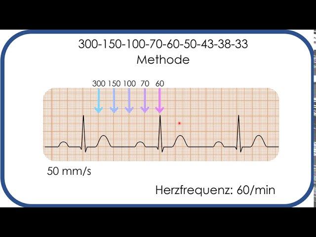 EKG-Befundung: Herzfrequenz in Sekunden bestimmen! (300-150-100-Methode)