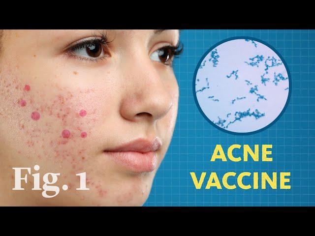 New science UNLOCKS a major cause of acne — AND a new treatment!