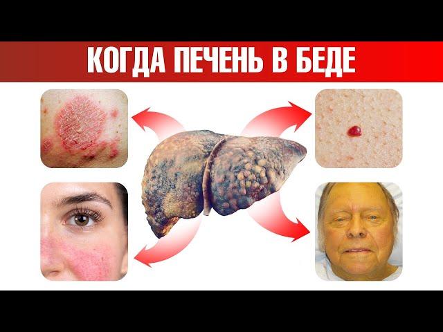 Проблемы с печенью: симптомы на кожеПроверьте себя