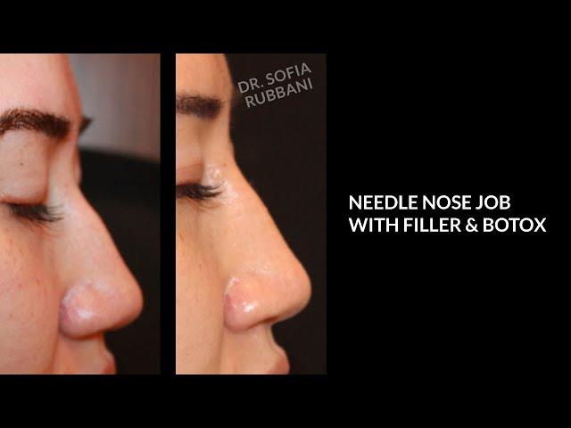 BEFORE & AFTER - Needle Nose Job in 5 minutes - by Dr. Rubbani