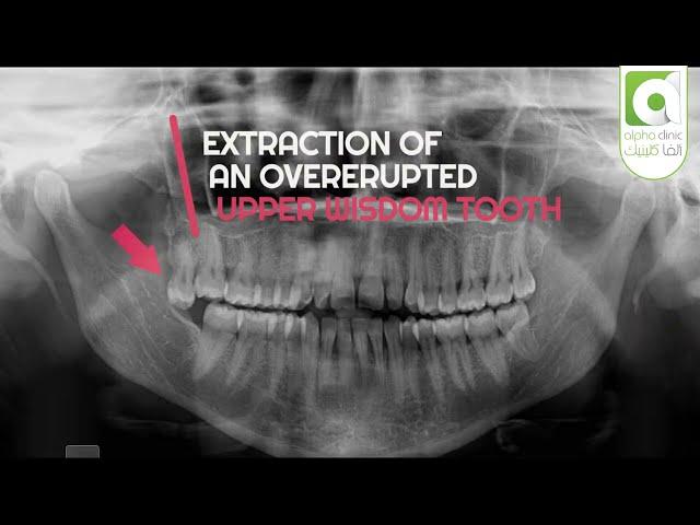 Non Surgical Extraction of Wisdom Tooth: Upper Right Maxillary Molar