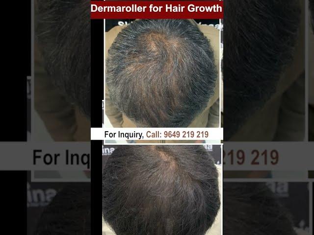 Derma Roller For Hair Growth Has The Answer To Everything #dermaroller_for_hairgrowth #skinaa_clinic