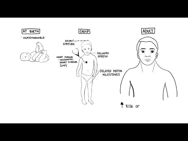 Noonan Syndrome a genetic condition