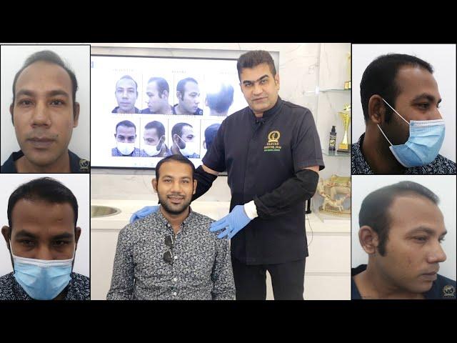 Hair Transplant Malaysia | SMART™ FUE Hair Transplant: 3-Month Review