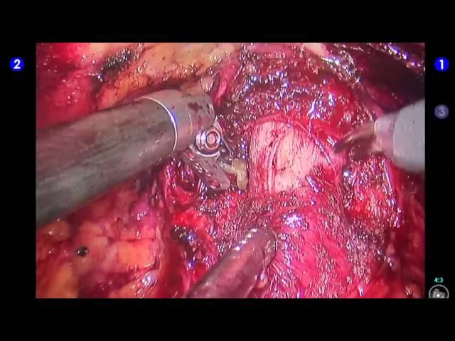 Incision of the bladder neck - Mesane boynu insizyonu